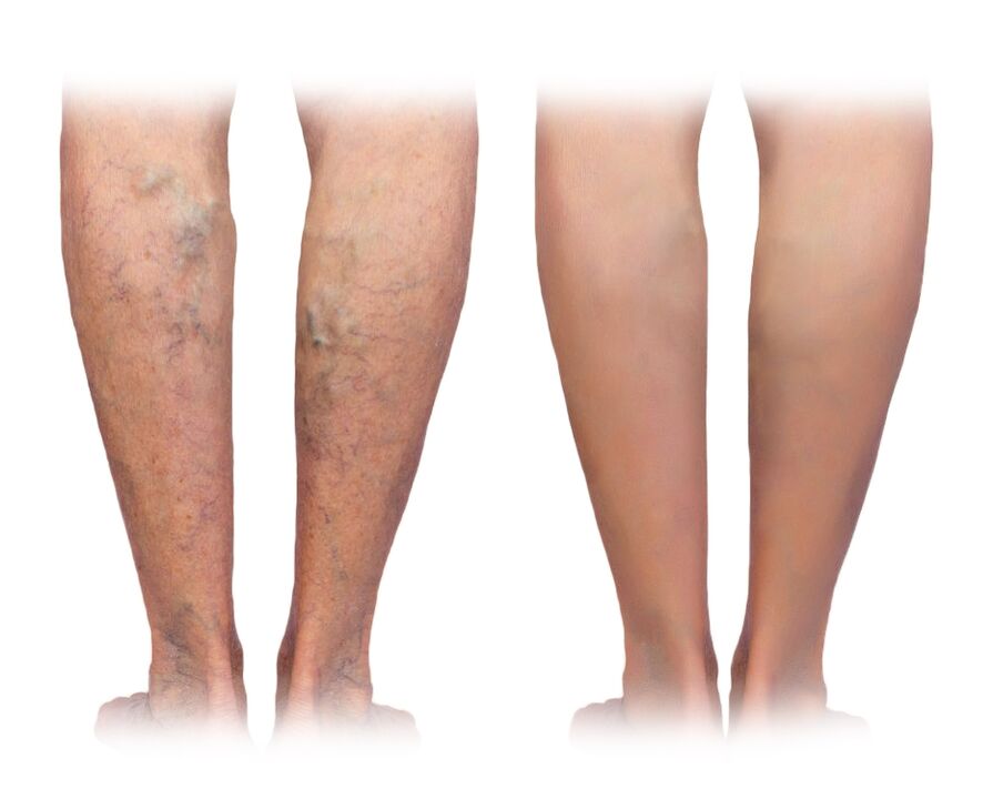 Gambe con vene varicose prima e dopo l'uso della crema Veniselle